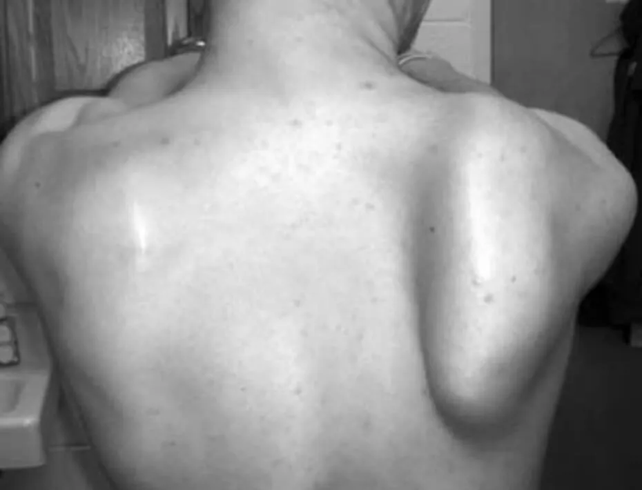 winging scapula