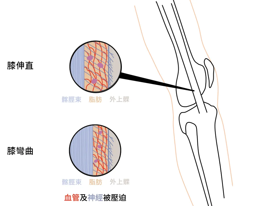 髂脛束張力上升會壓迫到血管及神經受器,產生疼痛